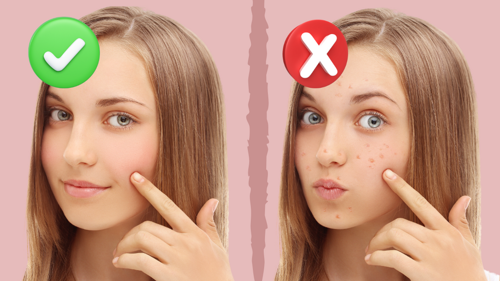 The Do's and Don'ts of Acne Treatment: Expert Advice for a Clear Complexion