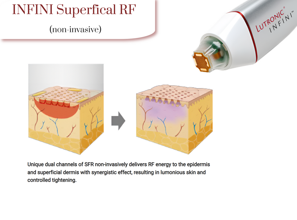 INFINI™ 3D RF Microneedling - West Vancouver | BN Skin & Laser Clinic