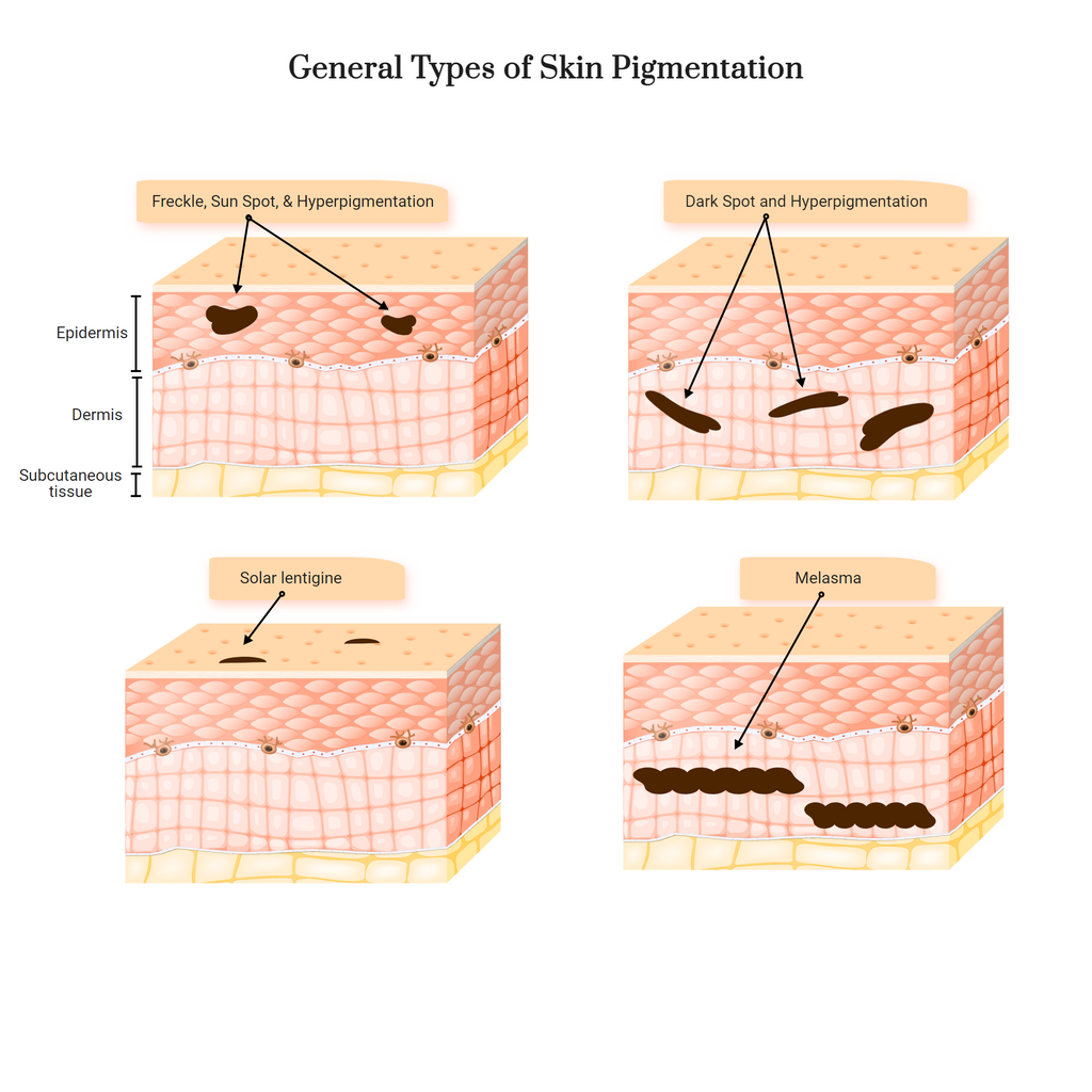 Patterned Pigmentation Pigmentations, Freckles, and Dark Spot Laser Treatments - West Vancouv