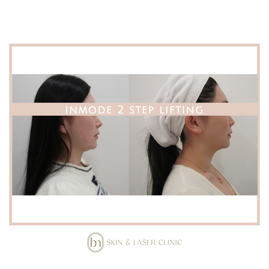InMode® 2 / 3 step Lifting - West Vancouver | BN Skin & Laser Clinic