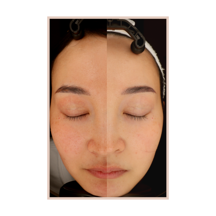 Rosacea | Diffuse Redness Treatments - West Vancouver | BN Skin & Lase