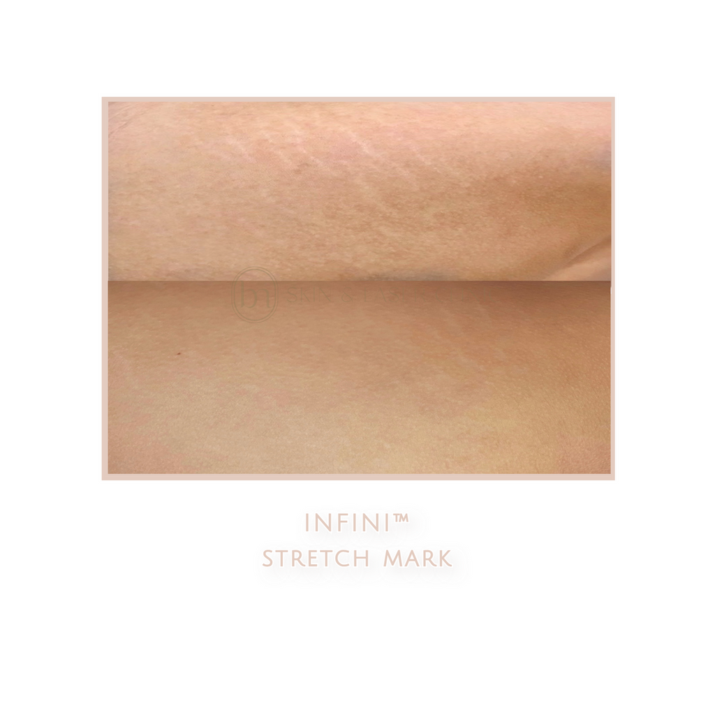 INFINI™ 3D RF Microneedling - West Vancouver | BN Skin & Laser Clinic
