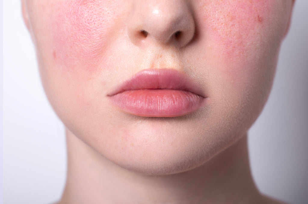 Rosacea | Diffuse Redness Treatments - West Vancouver | BN Skin & Lase