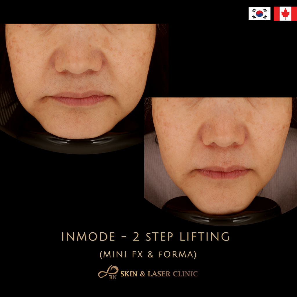 Inmode Skin InMode® 2 / 3 step Lifting - West Vancouver | BN Skin & Laser Clinic