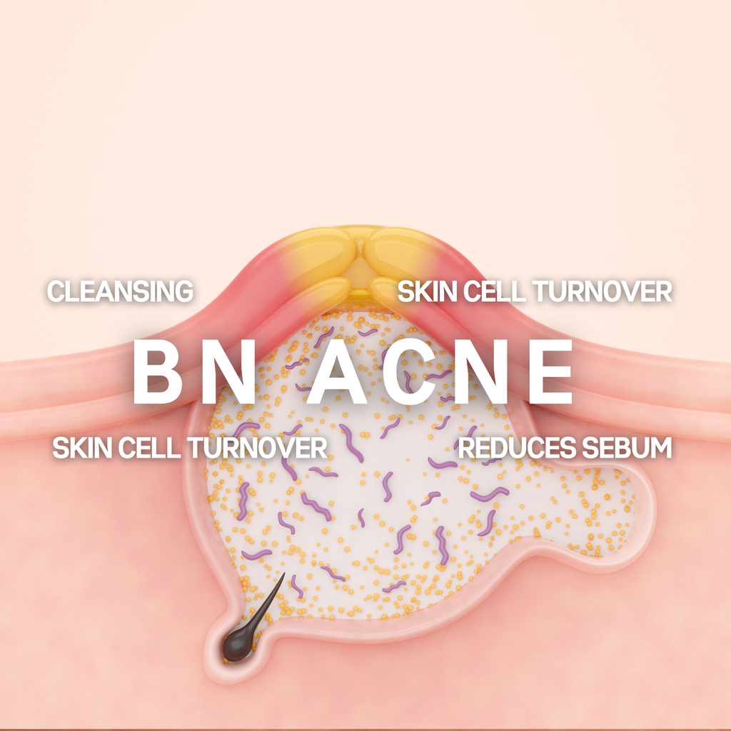 acne treatment illustration BN Skin & Laser Clinic Vancouver 여드름 밴쿠버